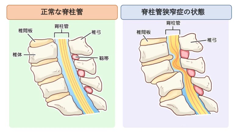 脊柱管狭窄症01